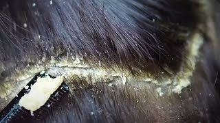 Dandruff scratching removal on head using black combing374 [upl. by Annaiek144]