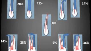 Primer premolar superiorwmv [upl. by Campney]