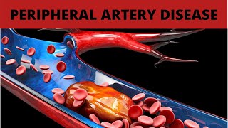 Treatment for Peripheral Artery Disease [upl. by Htebezile]