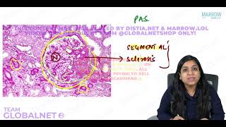 NEPHROTIC SYNDROME By Dr Illa jain khandelwal Pathology by Marrow Video Lecture [upl. by Rita594]