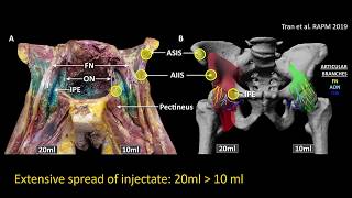 Pericapsular Nerve Group PENG block for hip analgesia [upl. by Tomasine]