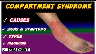 compartment syndrome [upl. by Carlynn]