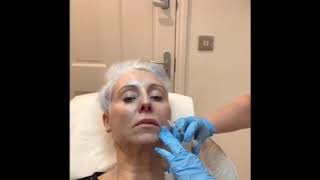 Belotero Lip filler treatment [upl. by Dowzall]