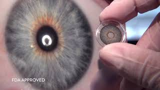 Can HumanOptics change “Human optics history” with its artificial iris [upl. by Abernon]