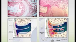 Rheumatoid Arthritis and Systemic Lupus Erythematosus Webinar [upl. by Odnomor]