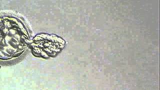 PGS  Diagnosi preimpianto delle aneuploidie cromosomiche [upl. by Kaye309]