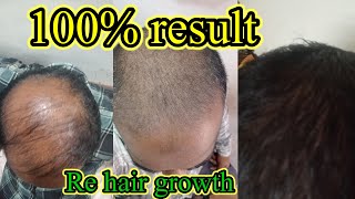 Re Hair growth treatment  बाल उगाणे का ट्रीटमेंट  hairgrowth hairtransformation [upl. by Kaiser]