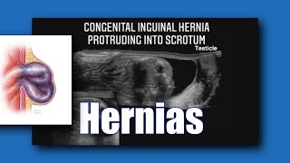 Sonoquickies Hernia [upl. by Eadith]