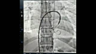 Successful Percutaneous Mitral Balloon Valvotomy of Patient With Tight Mitral Stenosis [upl. by Yllom]