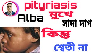 pityriasis Alba  মুখে সাদা দাগ। কিন্তু শ্বেতী না। জেনে নিন কি। কারণ ও চিকিৎসা। [upl. by Nylaroc]