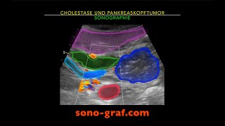 Sonographie  Cholestase und Pankreaskopftumor [upl. by Lednem]