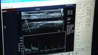 arterial blood flowwmv [upl. by Leynwad]