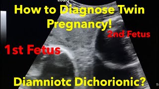 Twin Pregnancy  Diamniotic Dichorionic how to diagnose  easy steps [upl. by Antonetta976]