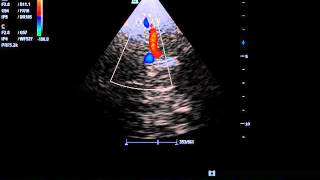 transcranial doppler in patient with hyperdynamic circulation due to anemia [upl. by Onder]