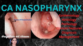 199Nasopharyngeal Carcinoma Part 13 epidemiology aetiologyclinical features nasopharynx [upl. by Murtha]