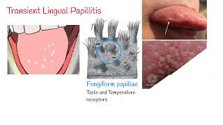 Transient lingual papillitis Lie Bumps  Inflammation of the tongue [upl. by Rosamund]