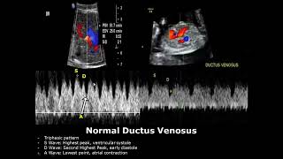 Fetal Ductus Venosus Doppler Ultrasound Normal Vs Abnormal Image Appearances  Spectral Doppler USG [upl. by Aloz875]