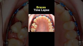 Braces time lapse Before and after transform braces orthodontist bracesoff dentist [upl. by Naillig]