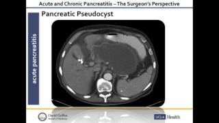 Acute and Chronic Pancreatitis  O Joe Hines MD  UCLA Digestive Diseases [upl. by Buff533]