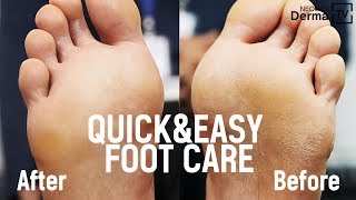 Fast and Easy Care to Remove Cracked Heels amp Foot Dead Skin Cells [upl. by Papke315]