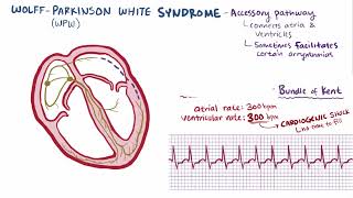 Wolff Parkinson White Syndrome  Osmosis [upl. by Rubia]