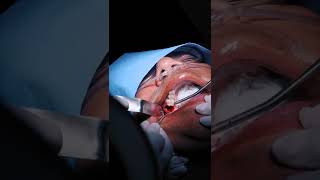 Dental Bone Graft for Implant Restoration  Torrance Oral Surgery amp Dental Implant Center [upl. by Brendis]