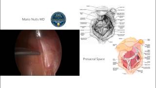 Laparoscopic Presacral Neurectomy [upl. by Neumark]