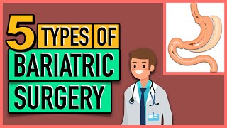 5 Types of Bariatric Surgery [upl. by Bertila]