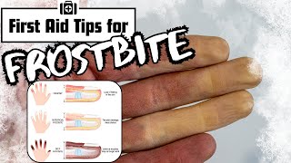 Frostbite  Symptoms and First Aid [upl. by Ppilihp]