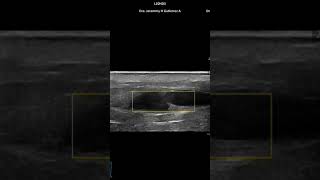 Incompetencia valvular Doppler Venoso Ecografia doppler Dra Jeremmy doctoraecos [upl. by Lorilyn]