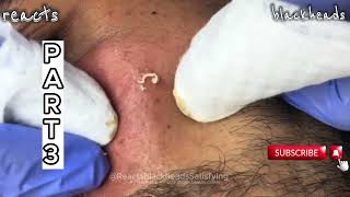 blackheads extractions blackheads and whiteheads removal blackheads new this week [upl. by Tatia]