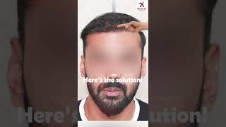 Struggling With Baldness  We Have a SOLUTION  hairtransformation besthairtransplantclinic [upl. by Janine729]