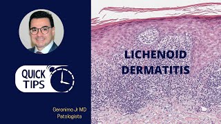 LICHENOID DERMATITIS PART I [upl. by Kendricks]