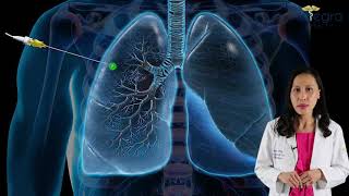 Diagnosing Lung Cancer by early identification of pulmonary nodules [upl. by Etnoval]