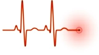 Easy EKG STEMI [upl. by Eicnan]