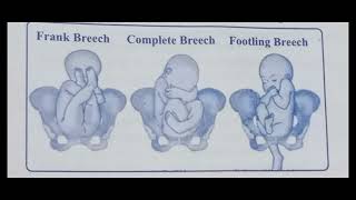 Breech presentation  obg  bsc nursing gnm  obg [upl. by Yanad]