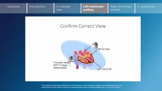 Key screening views of the fetal heart  Part 4  Left ventricular outflow [upl. by Lundin594]