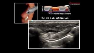 ULTRASOUND GUIDED INTERCOSTAL NERVE BLOCK [upl. by Derriey]