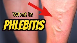 What is Phlebitis [upl. by Feinleib]