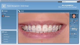 Planmeca Romexis® Smile Design  Smile Design in 2 Minutes [upl. by Pournaras]