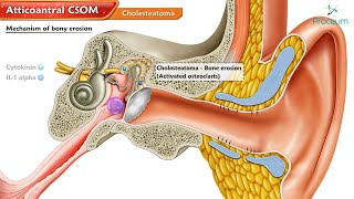 Atticoantral Chronic Suppurative Otitis Media CSOM and Cholesteatoma 🦻💡quot  Animated ENT Lectures [upl. by Eloci]