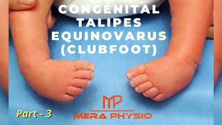 Congenital Talipes Equinovarus Clubfoot  pt 3  Physiotherapy Treatment  In Hindi  Mera Physio [upl. by Hesoj]