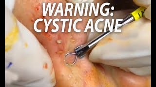 Cystic Acne Warning Cysts Whitehads Papules amp Blackheads [upl. by Quick]