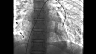 Hereditary Haemorrhagic Telangiectasia [upl. by Aramenta]