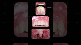 வாயில் ஏற்படும் பூஞ்சை தொற்று Oral Thrush Dr Isacc Abbas [upl. by Geller53]