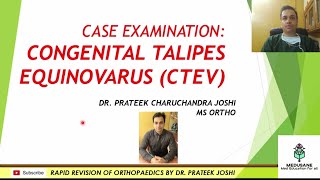 Congenital Talipes Equino Varus  Clinical Orthopaedics  DrPrateek Joshi MS MEDUSANE [upl. by Avaria]