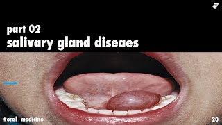 salivary gland diseases 2  oral medicine  عزت شومان [upl. by Sivra]