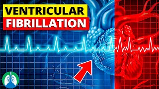 Ventricular Fibrillation Vfib  Medical Explainer Video [upl. by Enattirb]