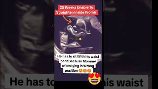 wrong baby position 25 weeks due to mothers position🥲🥲🥲viralvideo trending baby [upl. by Yatnuahs680]