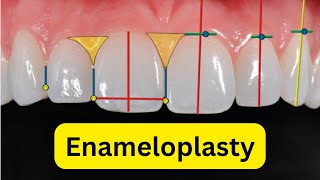 What is enameloplasty or odontoplasty [upl. by Kneeland]